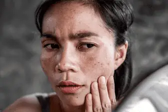 melasma (1).webp