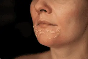 peeling-quimico (1).webp